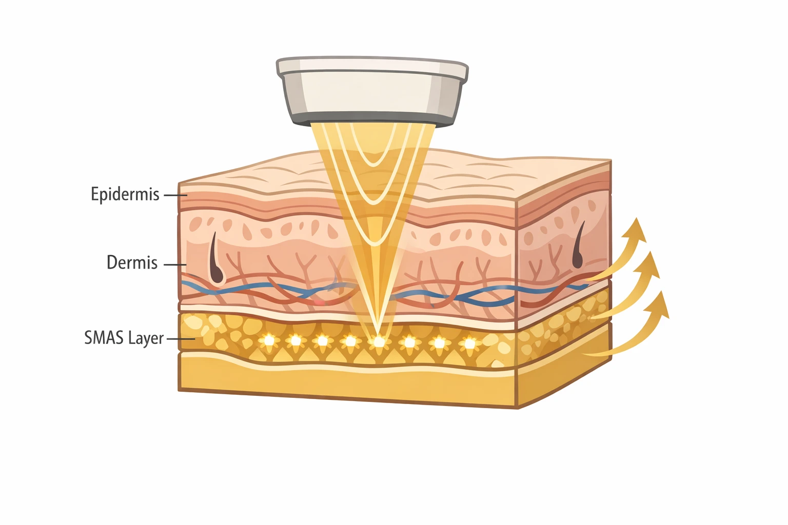 Skin Lifting Diagram